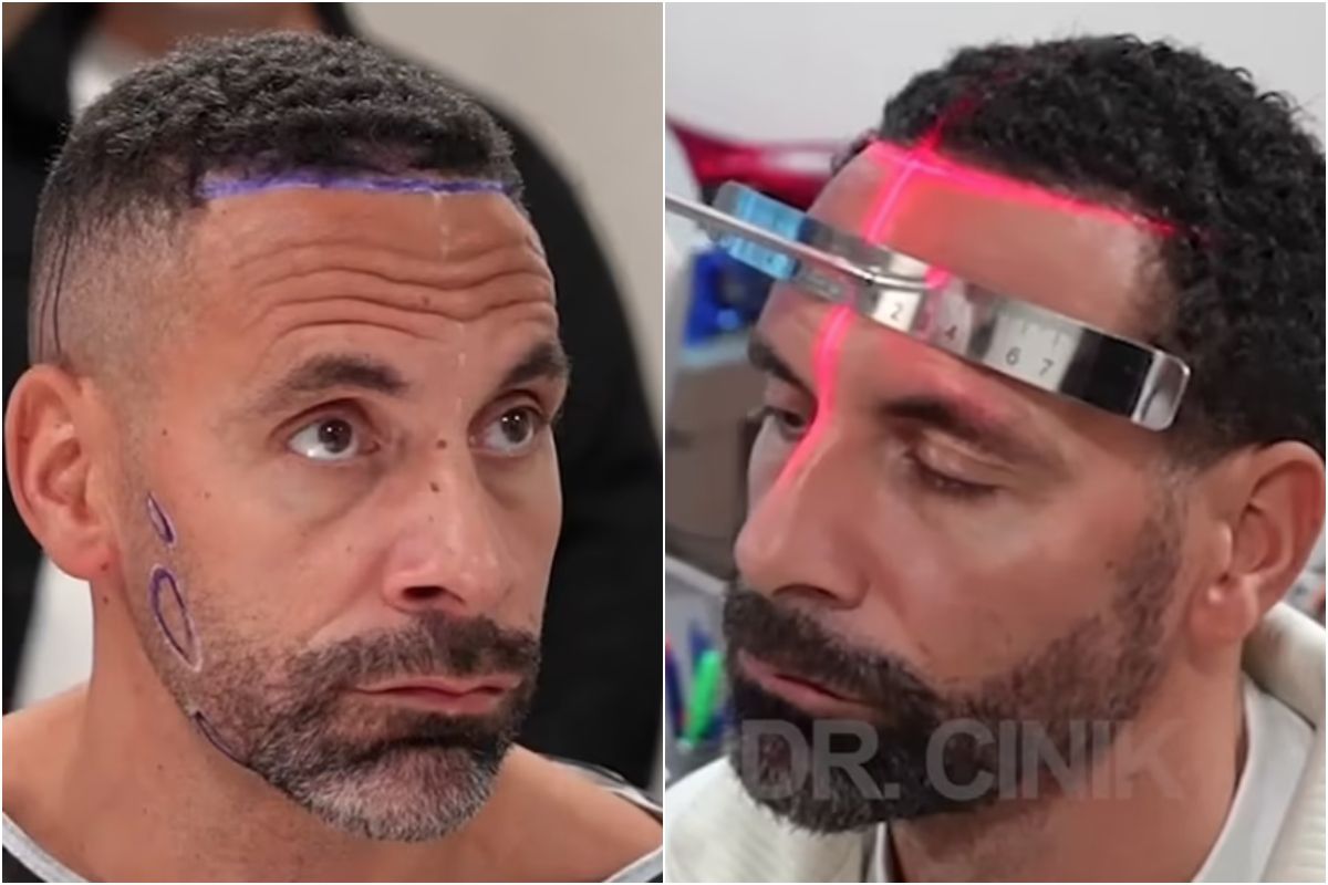 Ο Φέρντιναντ έκανε μεταμόσχευση μαλλιών και γενειάδας: «Επρεπε να γίνει, ήμουν σαν δαλματίας» (vid)